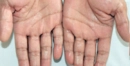 Avuç İçi Terlemesi Belirtileri ve Tedavisi